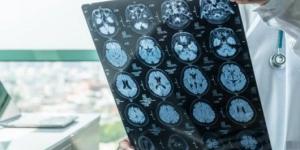 اجراءات طبية سريعة يجب اعتمادها عند حدوث الجلطة الدماغية