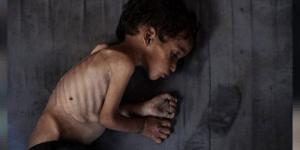 غزة.. ثماني وفيات جديدة نتيجة المجاعة وسوء التغذية