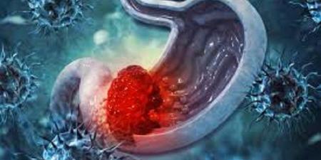 أدوية شائعة قد تؤدي إلى نتائج غير دقيقة لتحليل جرثومة المعدة