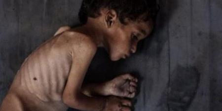 "الصحة" بغزة: ثمانية وفيات نتيجة المجاعة وسوء التغذية خلال الـ24 ساعة الماضية