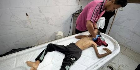 غزة..10 وفيات نتيجة المجاعة وسوء التغذية خلال الـ24 ساعة الماضية