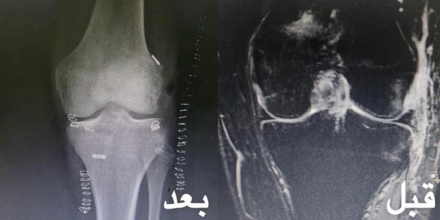 سعود الطبية: استبدال الرباط الصليبي الأمامي والجانبي لعشريني تعرض لحادث مروري بواسطة المنظار