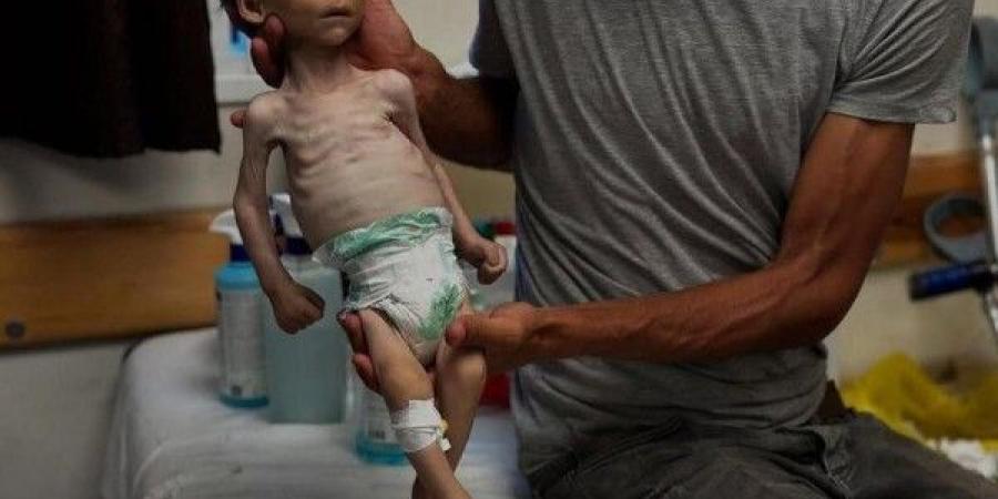 خلال 24 ساعة.. وفاة أربعة مواطنين بسبب سوء التغذية والمجاعة في قطاع غزة