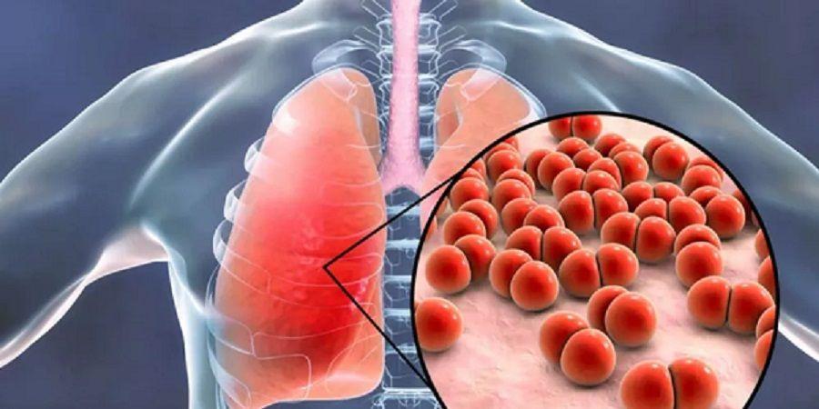 مرض السل.. الأعراض والأنواع وأهمية التشخيص المبكر