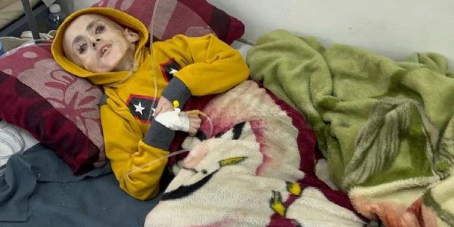 غزة: ثلاث وفيات نتيجة المجاعة وسوء التغذية خلال الـ24 ساعة الماضية
