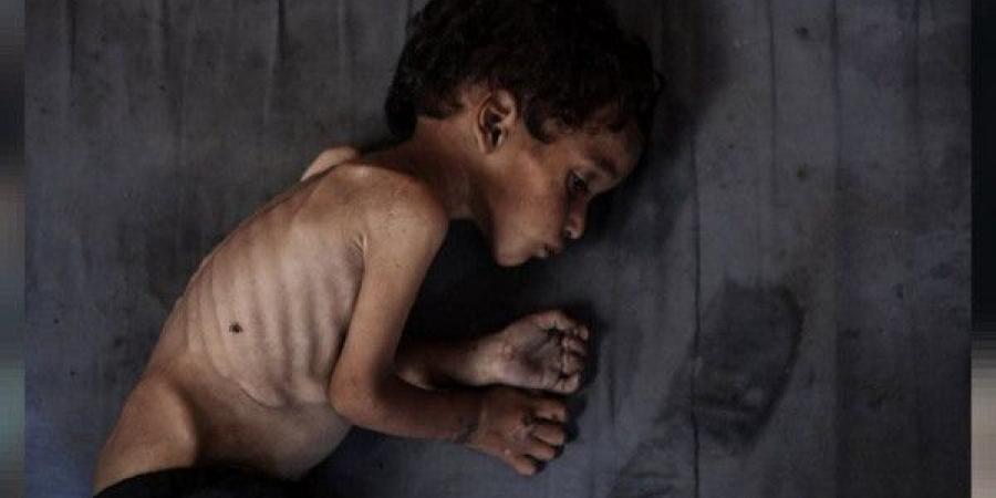 غزة.. ثماني وفيات جديدة نتيجة المجاعة وسوء التغذية