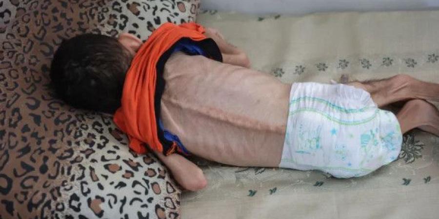 غزة: 11 وفاة نتيجة المجاعة وسوء التغذية خلال الـ 24 ساعة الماضية